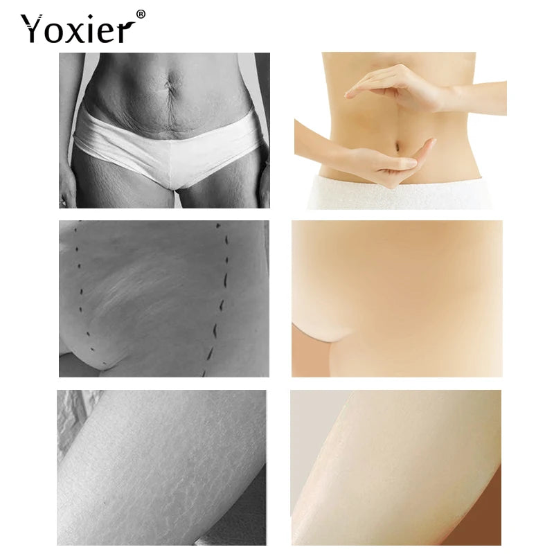 Cellulite Removal Treatment Cream
